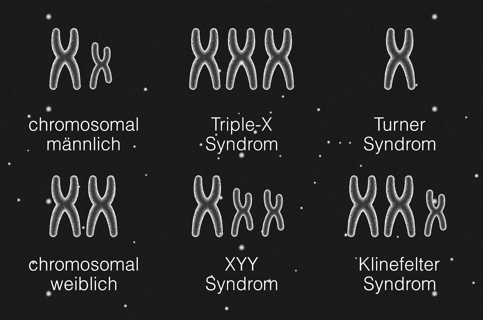 Das Bild zeigt die Verteilung der X- und Y-Chromosomen bei vier verschiedenen chromosomalen Varianten der Geschlechtsentwicklung. XY bei biologisch männlich. XX bei biologisch weiblich. XXX bei Triple X Syndrom. XYY beim XYY-Syndrom. X beim Turner-Syndrom. XXY beim Klinefelter-Sydnrom